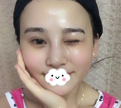 蚌埠韓美美萊整形醫(yī)生歷芳做耳軟骨隆鼻怎么樣？附耳軟骨隆鼻案例對(duì)比圖