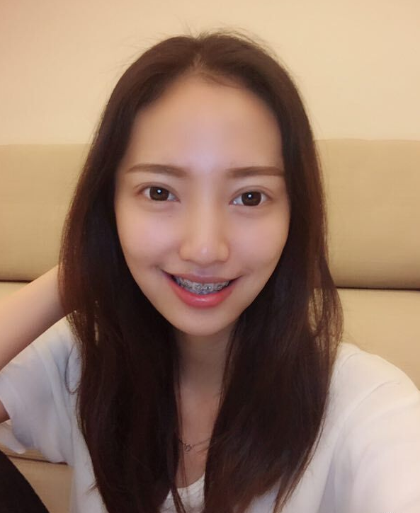 巴中華醫(yī)口腔醫(yī)院做牙齒矯正效果好嗎？附母汶靈醫(yī)生牙齒矯正案例效果圖