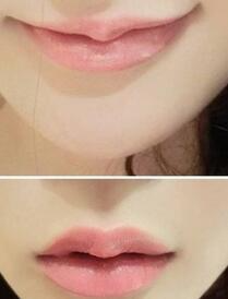 巴中時(shí)光醫(yī)學(xué)美容門(mén)診部做玻尿酸豐唇效果怎么樣？附李紅強(qiáng)豐唇案例