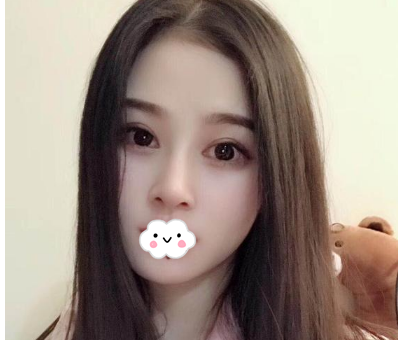 蚌埠韓美美萊整形醫(yī)生歷芳做耳軟骨隆鼻怎么樣？附耳軟骨隆鼻案例對(duì)比圖