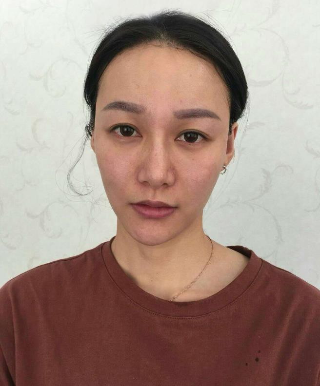 鞍山王景醫(yī)療美容外科診所做光子嫩膚怎么樣？附王景醫(yī)生案例效果圖