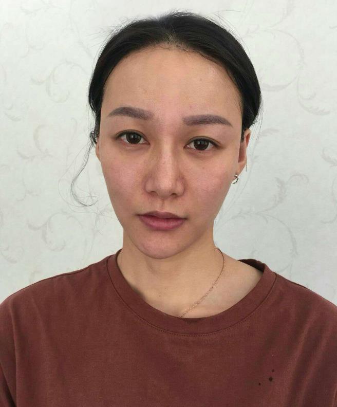 鞍山王景醫(yī)療美容外科診所做光子嫩膚怎么樣？附王景醫(yī)生案例效果圖