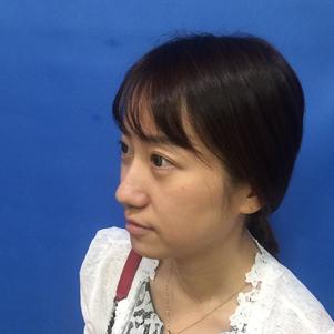 蚌埠韓美美萊整形做玻尿酸面部除皺效果怎么樣？附陳澤醫(yī)生案例效果圖