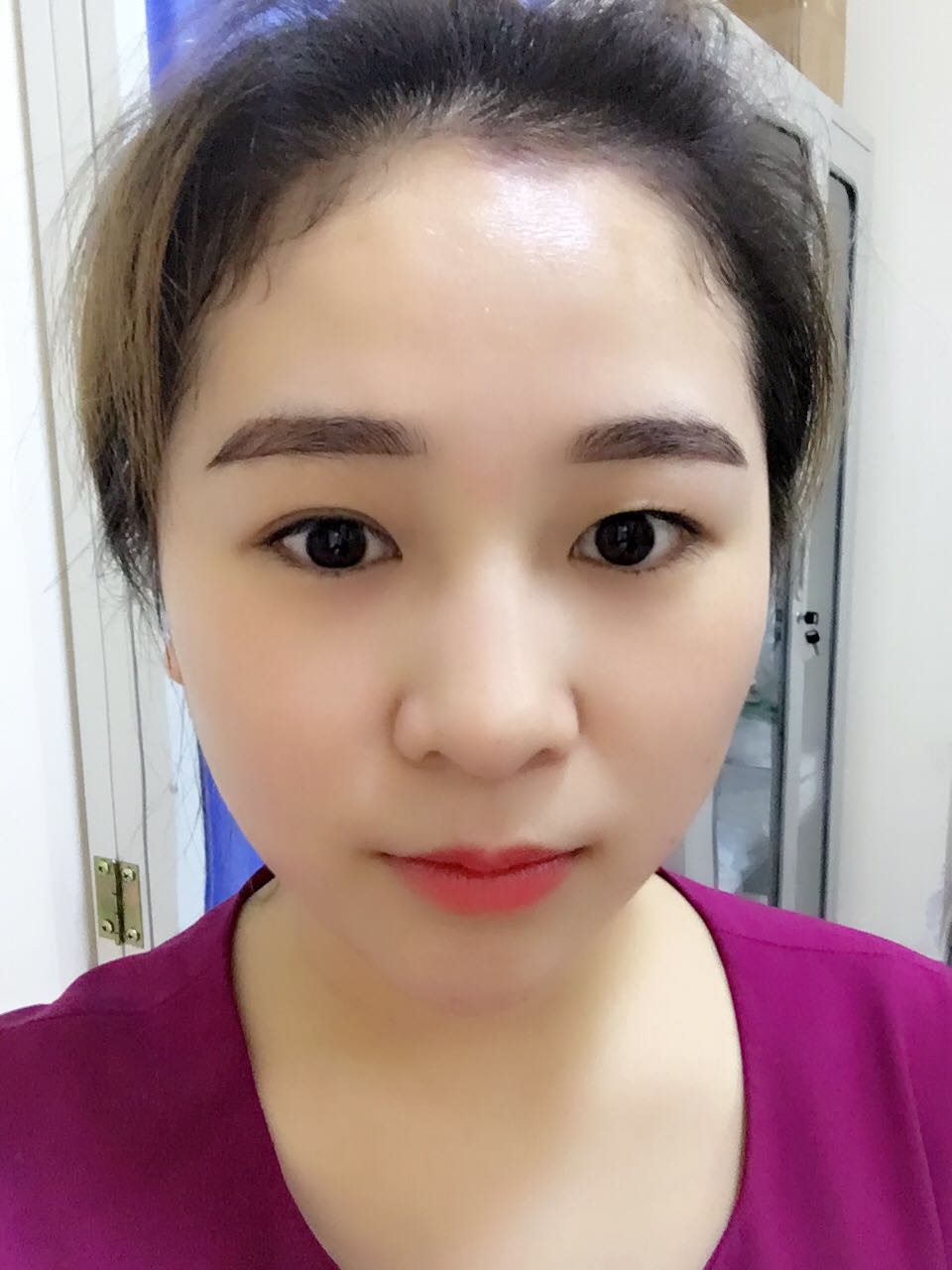 蚌埠韓美美萊整形醫(yī)生鄭捷做開眼角怎么樣？附案例效果圖