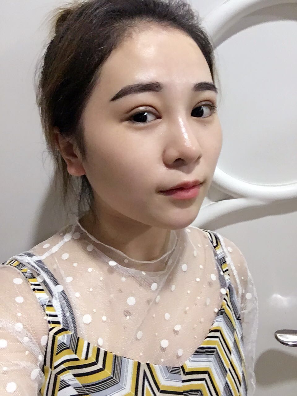蚌埠韓美美萊整形醫(yī)生鄭捷做開眼角怎么樣？附案例效果圖