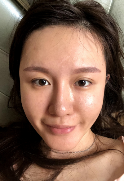 蚌埠韓美美萊整形醫(yī)生張燕做自體脂肪豐面頰效果怎么樣？附案例效果圖