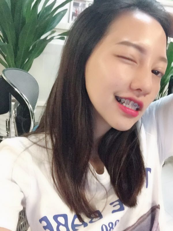 巴中華醫(yī)口腔醫(yī)院做牙齒矯正效果好嗎？附母汶靈醫(yī)生牙齒矯正案例效果圖