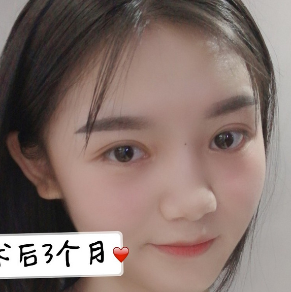 雙眼皮案例效果對(duì)比照