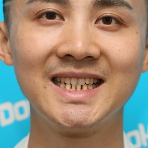 鞍山時代口腔門診部做瓷貼面案例效果圖