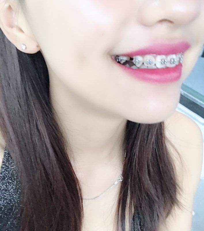 巴中華醫(yī)口腔醫(yī)院做牙齒矯正效果好嗎？附母汶靈醫(yī)生牙齒矯正案例效果圖