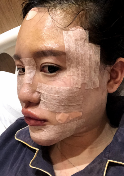 蚌埠韓美美萊整形醫(yī)生張燕做自體脂肪豐面頰效果怎么樣？附案例效果圖