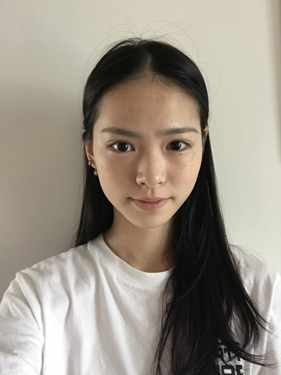 保定市第五醫(yī)院美容整形科做激光祛斑怎么樣？附單敬依醫(yī)生案例效果圖
