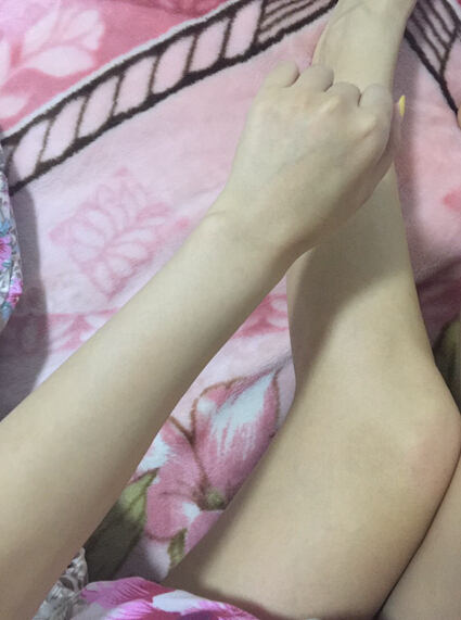 蚌埠市第三人民醫(yī)院燒傷整形科李方奇注射美白針效果怎么樣？安全嗎？附案例