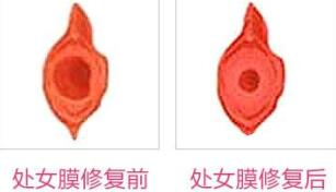 蚌埠市第三人民醫(yī)院燒傷整形科許瑾醫(yī)生做處女摸修復(fù)怎么樣？附案例
