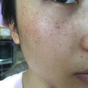 寶雞皮膚病醫(yī)院文東亮醫(yī)生做臉部祛斑效果怎么樣？附臉部祛斑案例