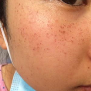寶雞皮膚病醫(yī)院文東亮醫(yī)生做臉部祛斑效果怎么樣？附臉部祛斑案例