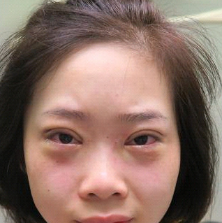 保定安卓貝拉醫(yī)療美容門診部孫大山醫(yī)生做雙眼皮+去眼袋怎么樣？附案例效果對(duì)比圖