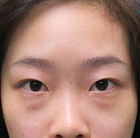 保定安卓貝拉醫(yī)療美容門診部孫大山醫(yī)生做雙眼皮+去眼袋怎么樣？附案例效果對(duì)比圖