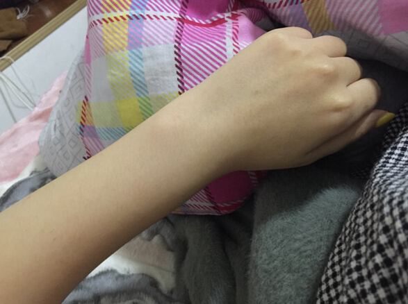 蚌埠市第三人民醫(yī)院燒傷整形科李方奇注射美白針效果怎么樣？安全嗎？附案例