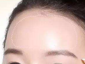貴陽(yáng)利美康醫(yī)院自體脂肪豐額頭