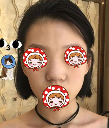 蘇州愛思特醫(yī)療美容醫(yī)院歪鼻矯正手術(shù)前的效果