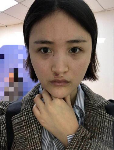 蘇州愛思特醫(yī)療美容醫(yī)院自體脂肪隆鼻手術前效果