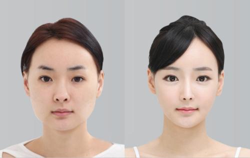 想做歐式雙眼皮，什么是歐式雙眼皮？