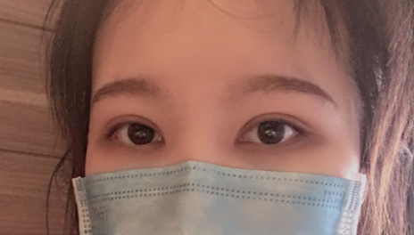 全切雙眼皮會(huì)越來(lái)越窄嗎？