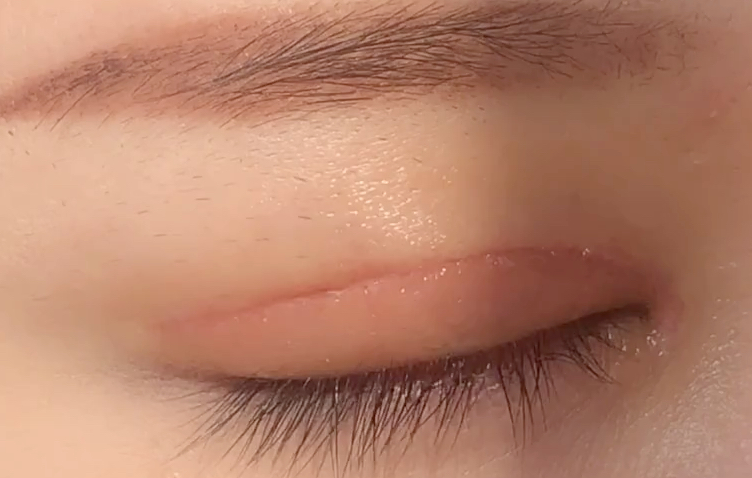 全切雙眼皮多久恢復(fù)？全切開雙眼皮有哪些優(yōu)點(diǎn)？