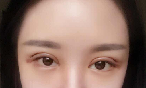 全切雙眼皮手術(shù)多少錢(qián)一次？