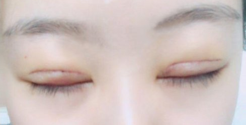 全切雙眼皮術(shù)后會留疤嗎？