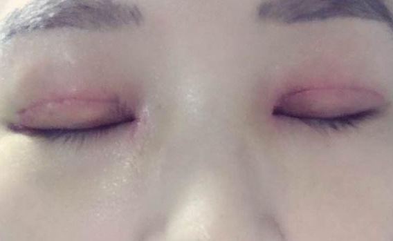 全切雙眼皮不對(duì)稱怎么辦？