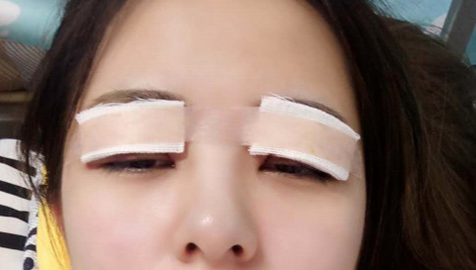 全切雙眼皮怎么恢復快？