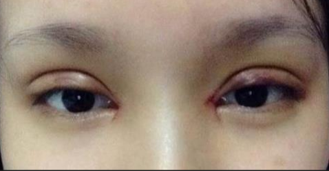 全切雙眼皮一般多久才能消腫？全切雙眼皮術后如何護理？