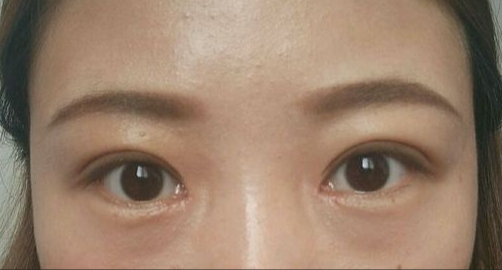 全切雙眼皮能保持多久？