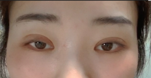什么是全切雙眼皮？全切雙眼皮的恢復(fù)時(shí)間？
