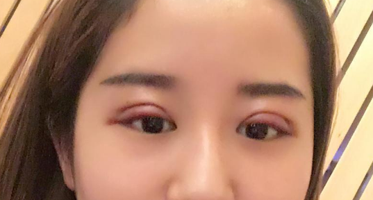 全切雙眼皮好不好？全切雙眼皮多長時(shí)間恢復(fù)自然？