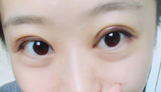 全切雙眼皮手術(shù)時(shí)間？全切雙眼皮術(shù)后會(huì)反彈嗎？