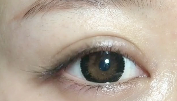 全切雙眼皮失敗可以修復(fù)嗎？