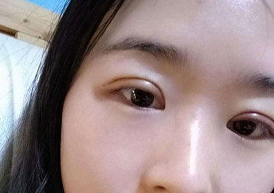 全切雙眼皮大概多少錢？全切雙眼皮多久能恢復(fù)？
