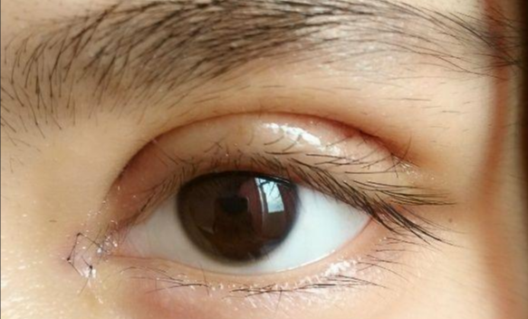 全切雙眼皮會(huì)留疤嗎？