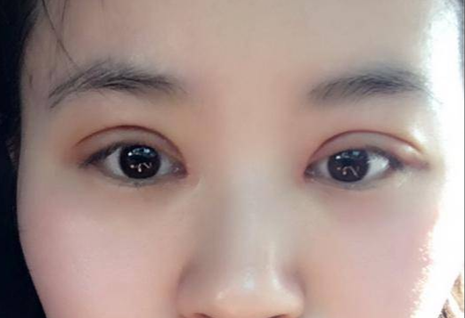 做全切雙眼皮多少錢？