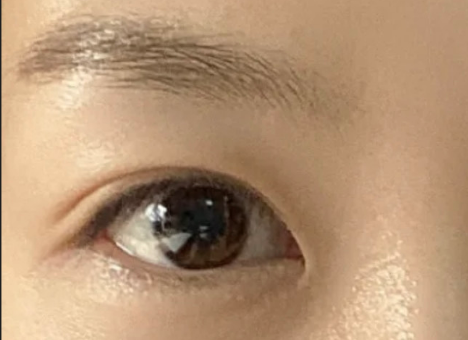 全切雙眼皮效果怎么樣？全切雙眼皮多久自然？