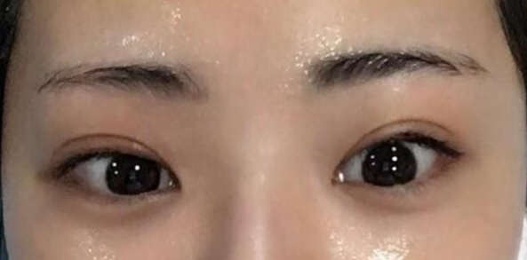 全切雙眼皮適合哪些人？
