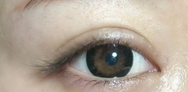 雙眼皮做埋線好還是全切好？