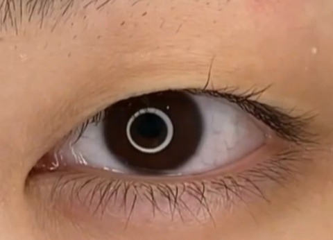 全切雙眼皮疤痕多久能消失？全切雙眼皮幾天可以洗臉？