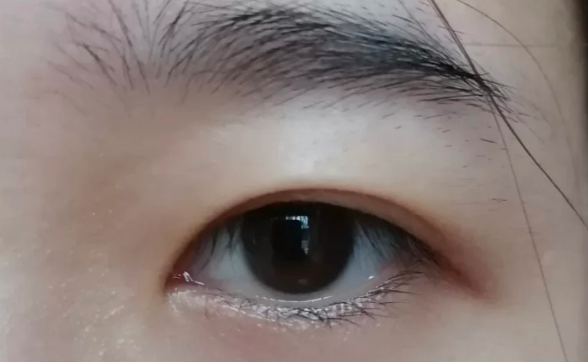 雙眼皮全切好還是韓式三點(diǎn)微創(chuàng)好？
