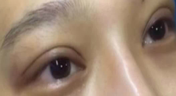 埋線雙眼皮大概能保持幾年？