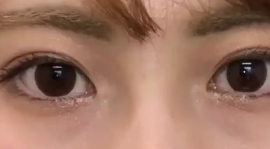 雙眼皮埋線后還可以開眼角嗎？做埋線雙眼皮有什么危險？