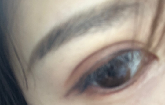 埋線雙眼皮手術(shù)優(yōu)勢(shì)有哪些？